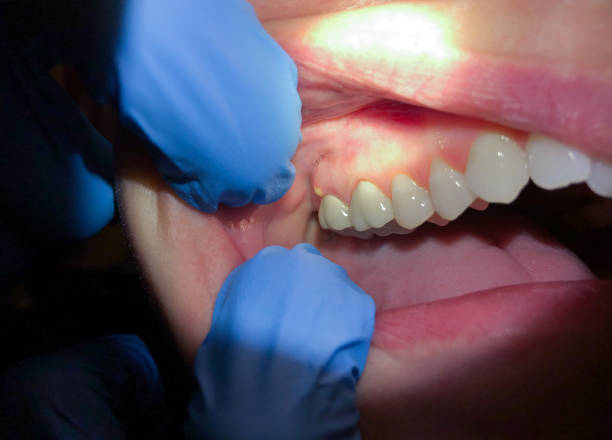 Best Broken or Cracked Tooth Emergency Dentist in Garden City South, NY